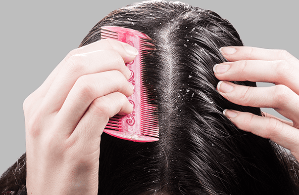 Dandruff Treatment at Home