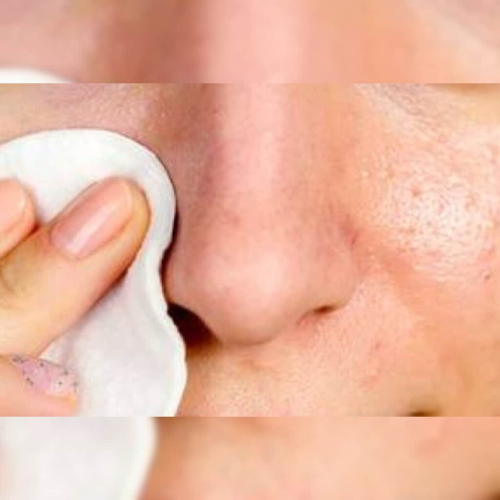 Best Blackhead Removing Techniques
