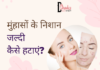 मुंहासों के निशान जल्दी कैसे हटाएं? – How to Remove Acne Scars how to remove acne scars
