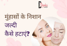 मुंहासों के निशान जल्दी कैसे हटाएं? – How to Remove Acne Scars how to remove acne scars
