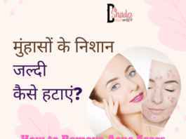 मुंहासों के निशान जल्दी कैसे हटाएं? – How to Remove Acne Scars how to remove acne scars